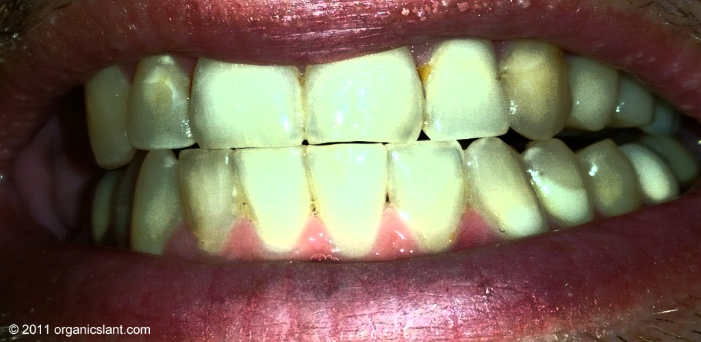 amalgam-fillings-in-your-mouth-are-poisoning-you-video-1024w